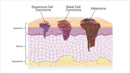 Types of Skin Cancer and their Level of penetration