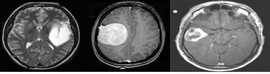 Brain MRI Images