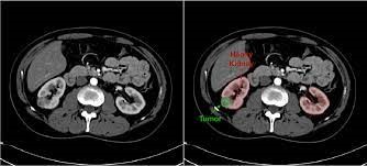 Abnormalities in   Kidney CT Scan Images